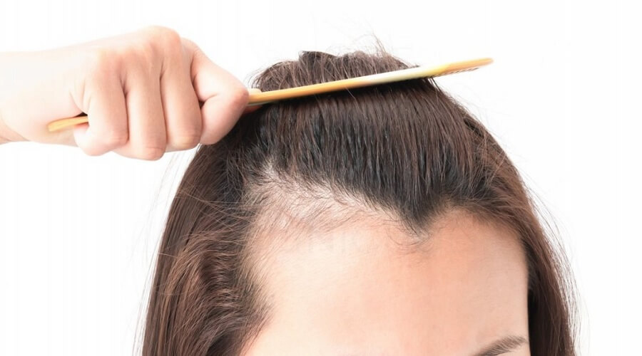 Female Hair Transplant